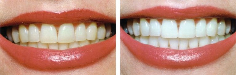 before and after teeth whitening procedure